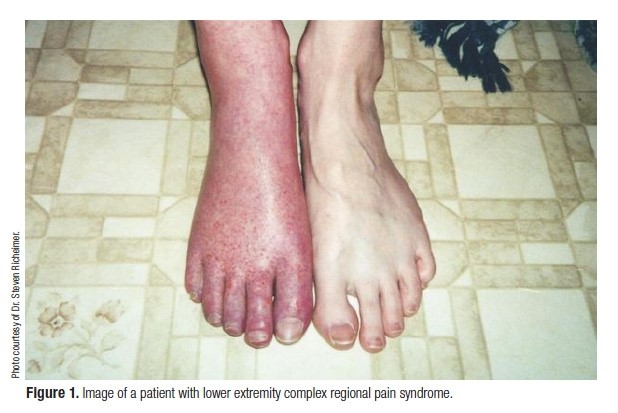 complex-regional-pain-syndrome-type-1-2-causes-symptoms