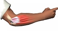 Physical therapy for tennis elbow