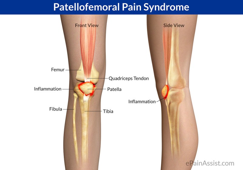 Patellofemoral pain syndrome causes knee pain in runners