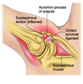 Queensbury and Malta physical therapy for Subacromial Impingement Syndrome