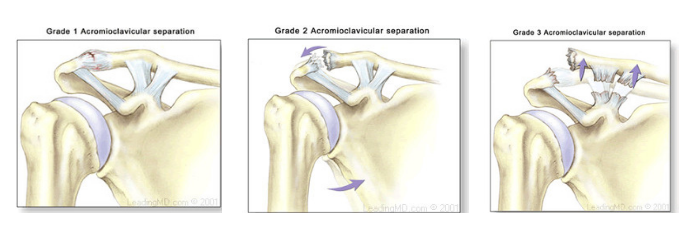 Separated Shoulder Symptoms, Treatment and Prevention - Capital Area PT &  Wellness