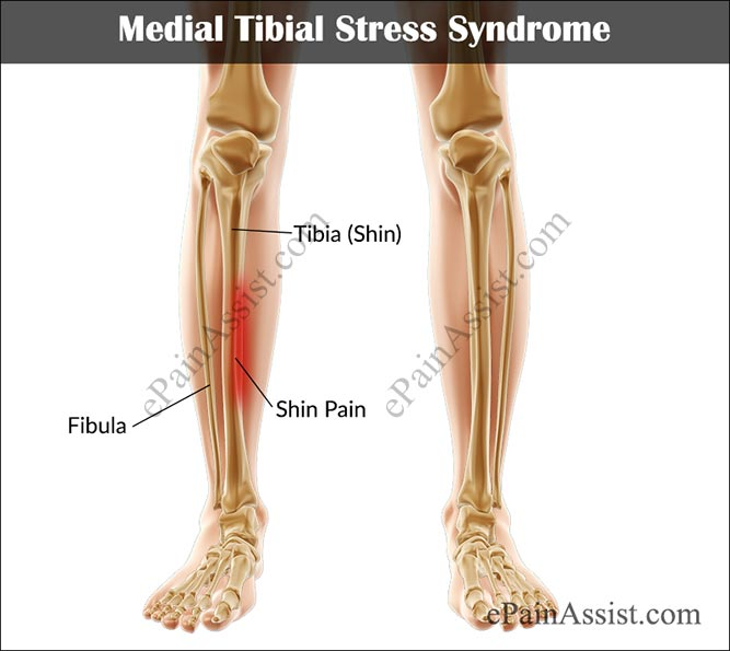 medial tibial stress syndrome bone scan