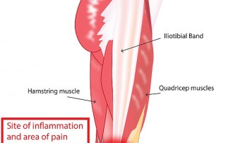 Iliotibial band syndrome graphic