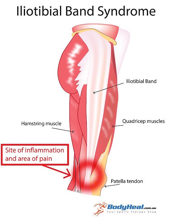 Iliotibial band syndrome graphic