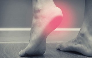 plantar fasciitis