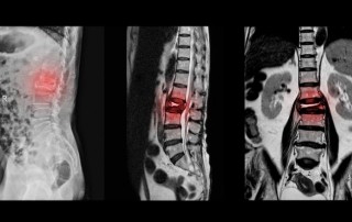 spinal stenosis