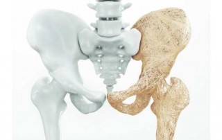 physical therapy for osteoporosis