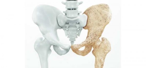 physical therapy for osteoporosis