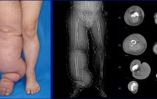 Lymphedema in the CT scan