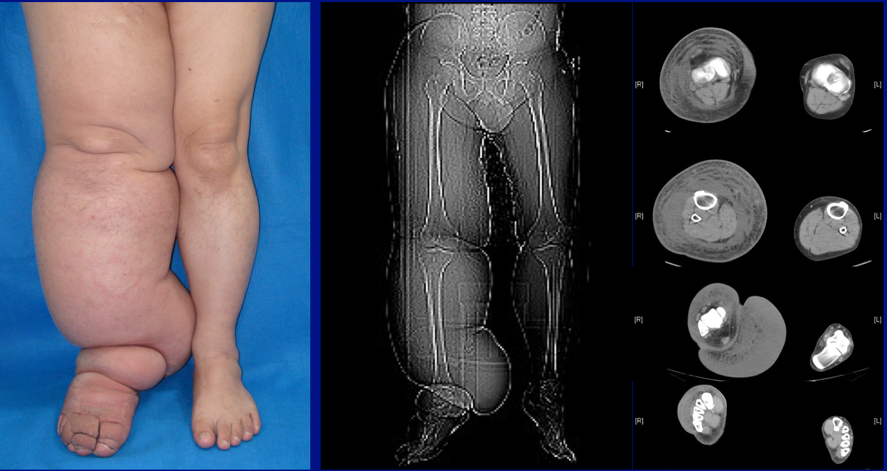 Lymphedema in the CT scan