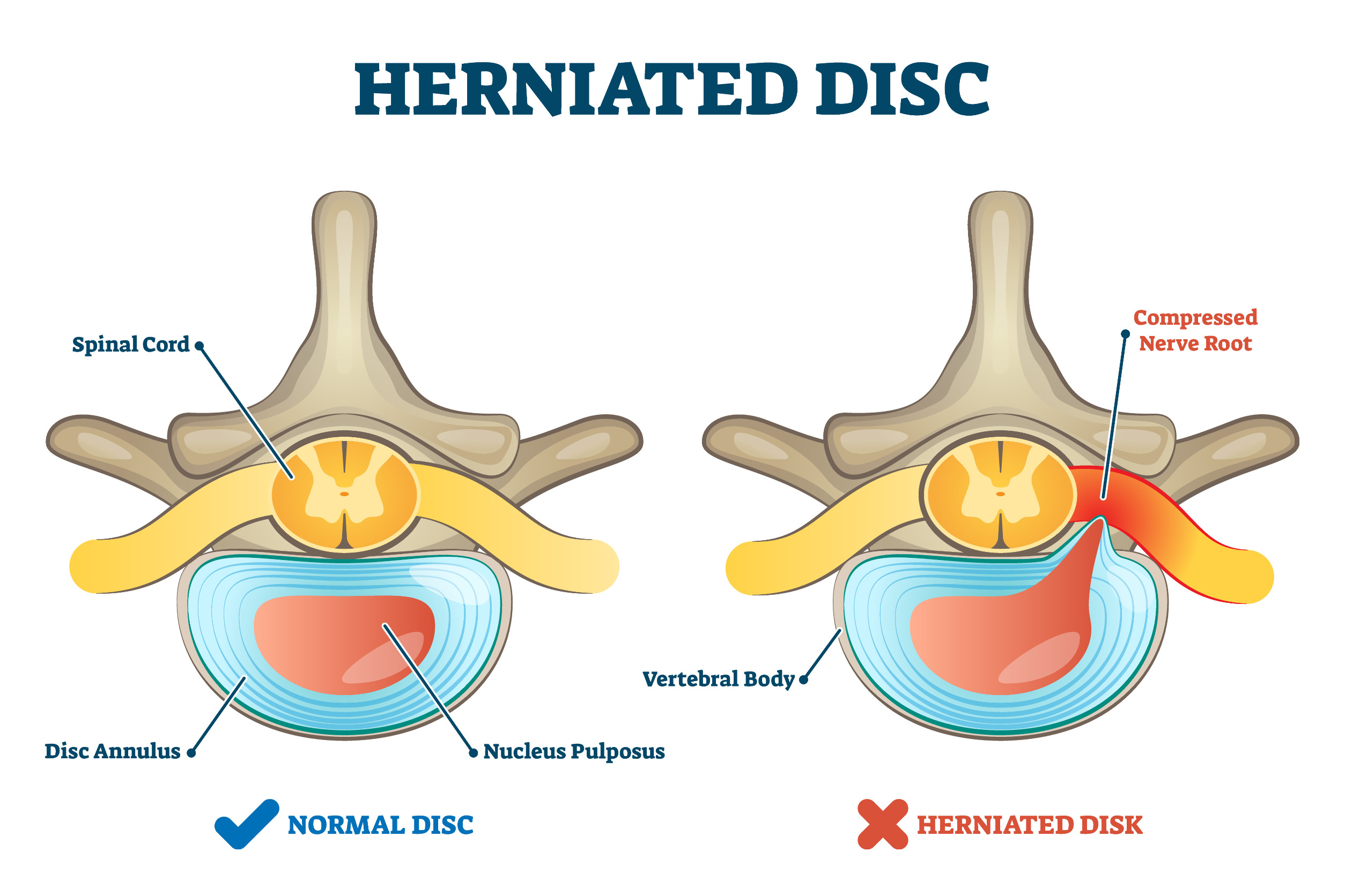 intervertebral disc herniation