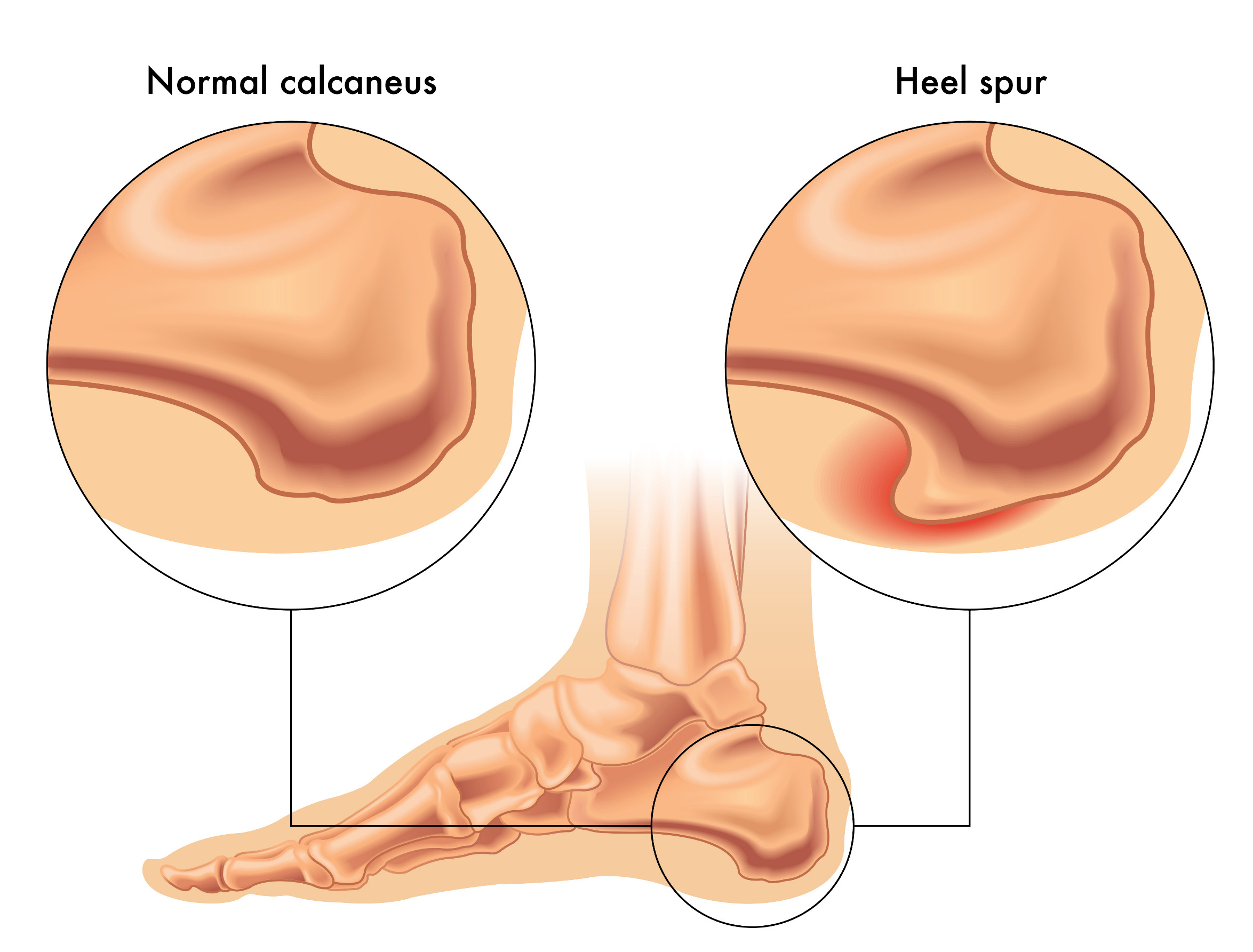 Heel Spur or Calcaneal Spur | How to cure Heel Pain | एड़ी का दर्द कैसे ठीक  करे - YouTube