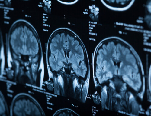 Post Concussion Syndrome (PCS)