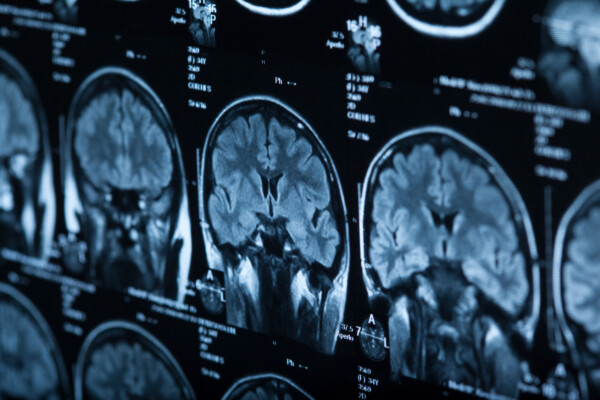 brain injury