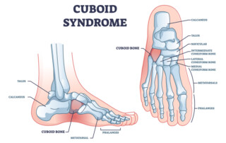 cuboid syndrome