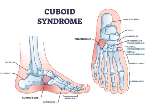 What is Cuboid Syndrome? 